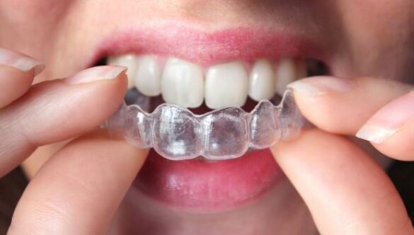 ข้อดีและข้อเสียของการจัดฟันใสแบบ Invisalign