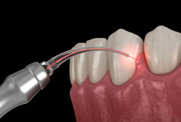Gum correction surgery with laser.  Medically accurate tooth 3D illustration