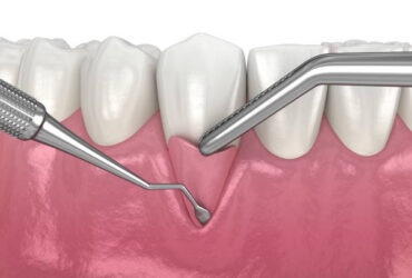 Gum Recession: Soft tissue graft surgery. 3D illustration of Dental  treatment