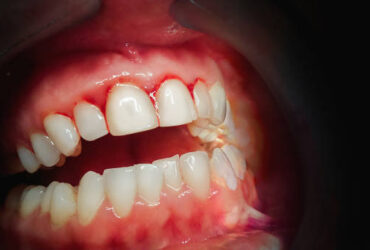 Mouth with bleeding gums on a dark background. Close up.
