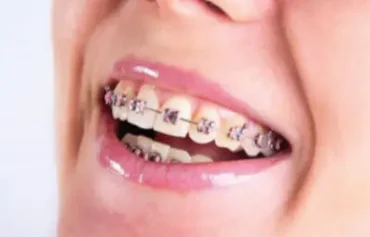 จัดฟันโลหะ จัดฟันยางสี