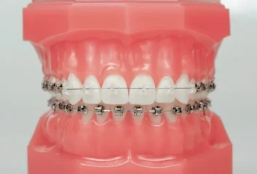 Damon_Clear_Q_Typodont-830x800