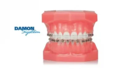 จัดฟันดามอน Damon