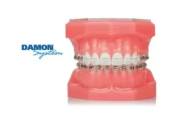 จัดฟันดามอน Damon