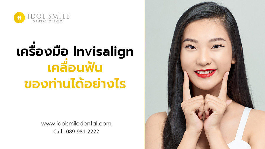 เครื่องมือ Invisalign เคลื่อนฟันของท่านได้อย่างไร